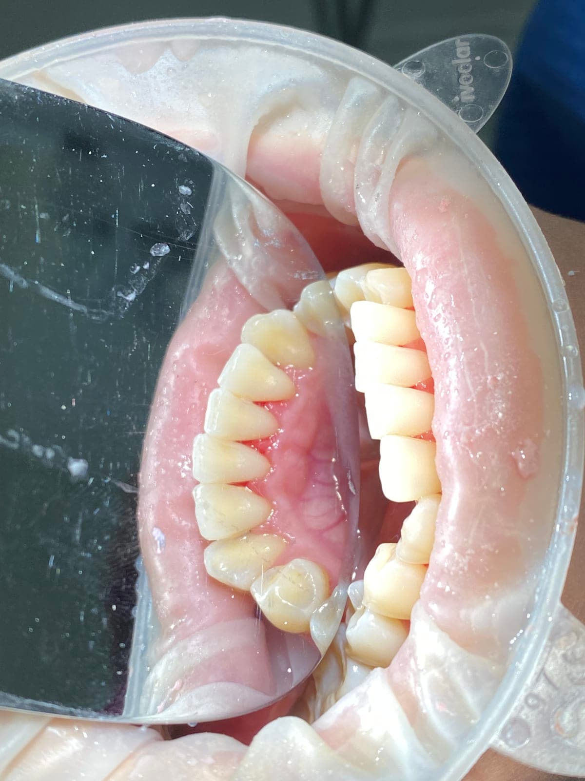 LIMPIEZA DENTAL