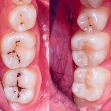 RESINAS DENTALES