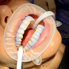 BLANQUEAMIENTO DENTAL
